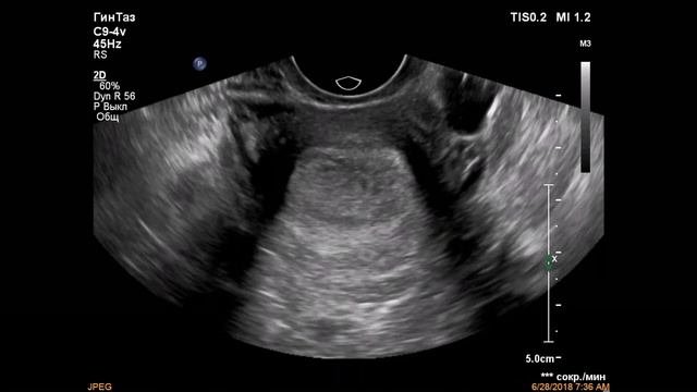 Крупный полип эндометрия/Large endometrial polyp