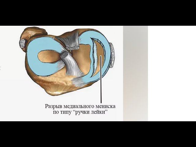 Ручка лейки.История повреждения мениска.