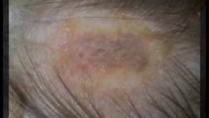 Как выглядит микроспория у человека?