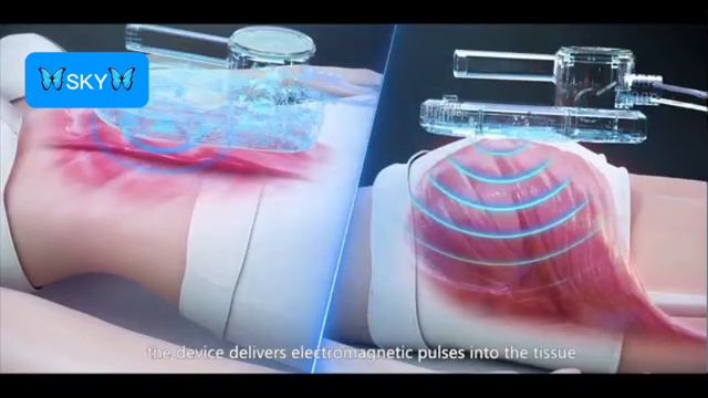 Emsculpt (миостимуляция) коррекция фигуры