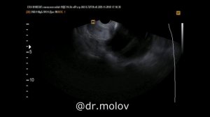 Муцинозная цистаденокарцинома правого яичника на УЗИ