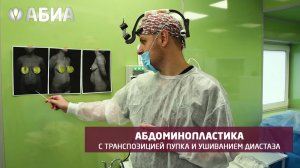 Абдоминопластика с транспозицией пупка и ушиванием диастаза в клинике "АБИА"