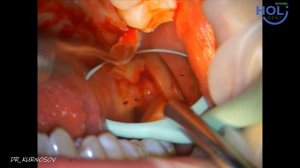 ССТ с области бугра верхней челюсти