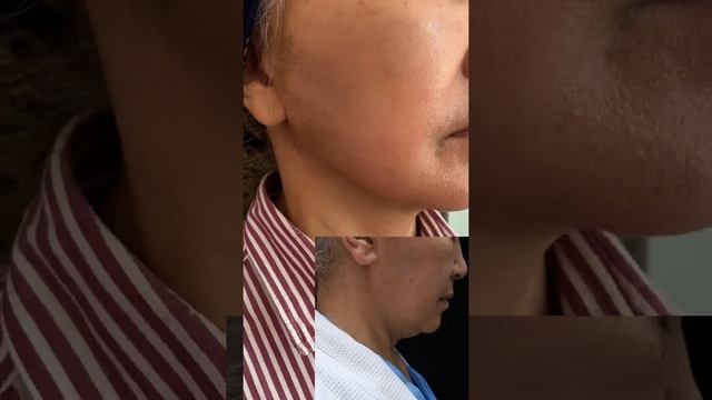 Подтяжка лица. Хирургический SMAS-lifting смотреть онлайн