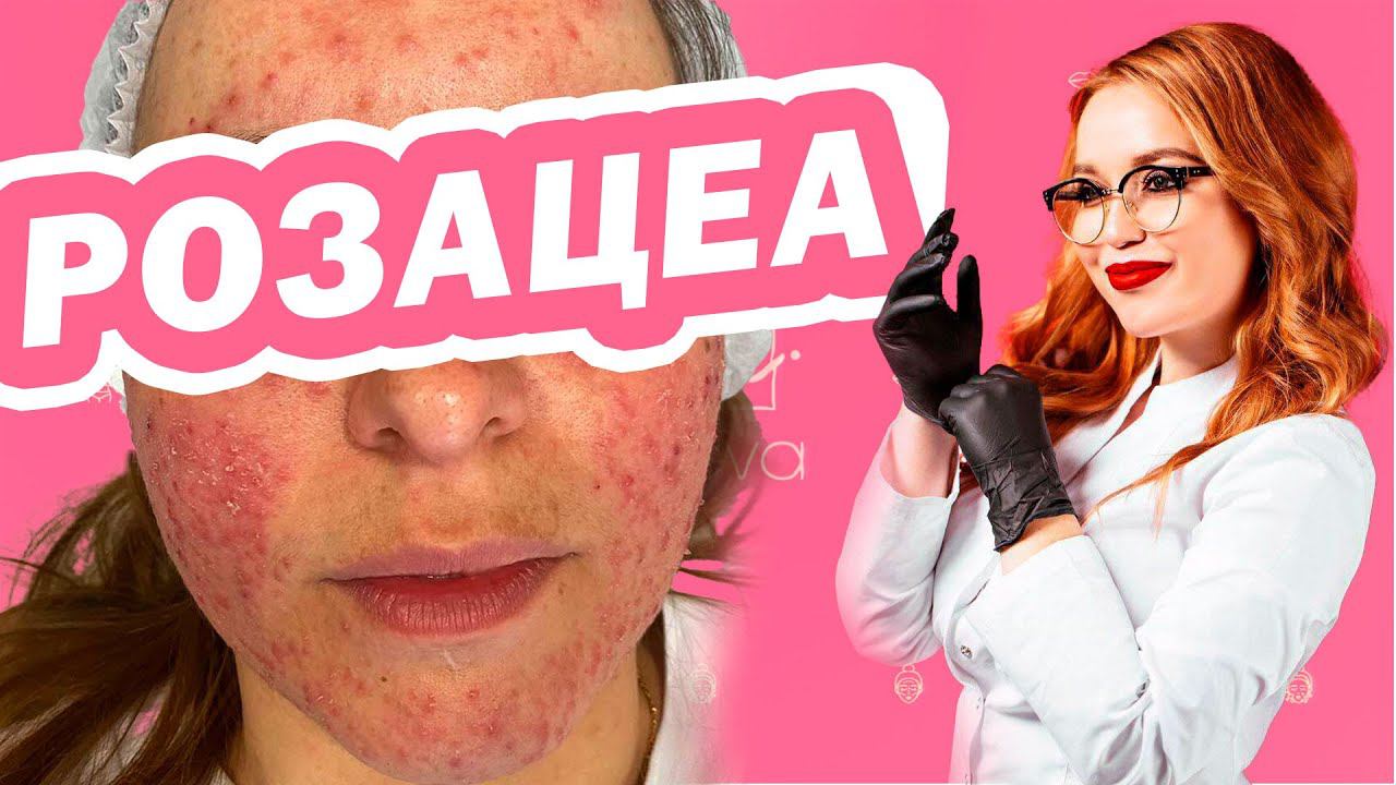 РОЗАЦЕА что это такое и как лечить? (КУПЕРОЗ, или РОЗОВЫЕ УГРИ)