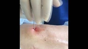 Ручной метод введение цемента