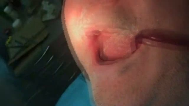 Протезирование пациента "К". Часть 1. Дневник врача- интерна. 4-я стоматология (архивное видео). смотреть онлайн