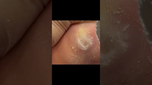 Be careful! Corns on soles of feet repaired!