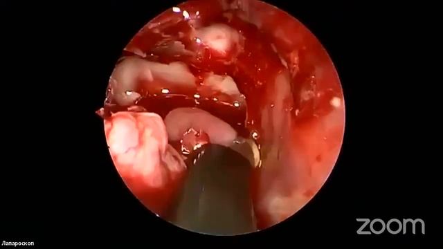 Семинар Мастер-класс на тему FESS смотреть онлайн