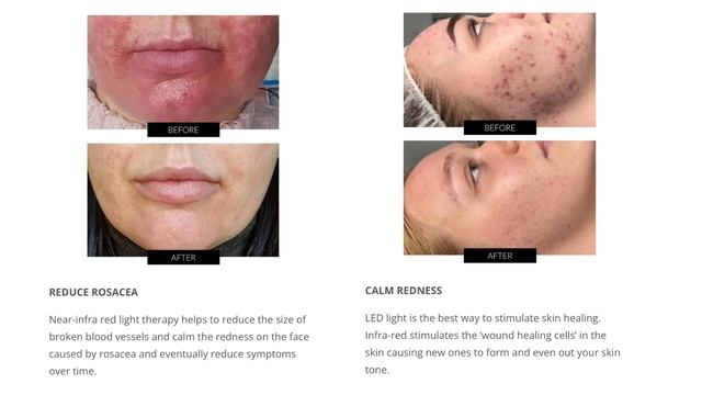 SEE WHAT DERMALUX FLEX MD DID FOR MY SKIN IN 5 DAYS | W BEFORE & AFTERS, DEMO & COMPARISONS смотреть онлайн