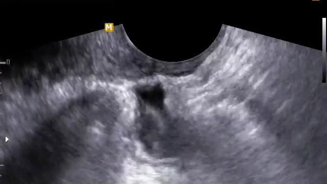 Эндометриоз толстой кишки смотреть онлайн