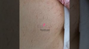 Результат от электроэпиляции