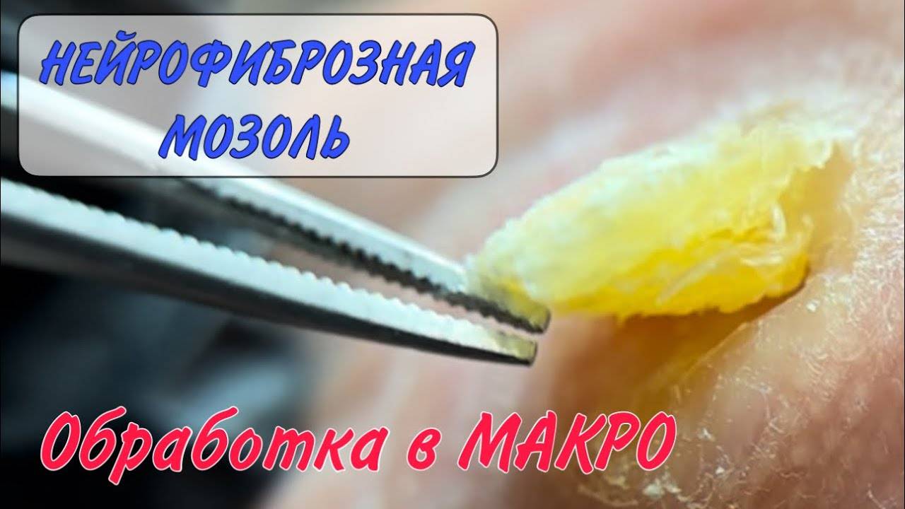 ‼️мозоль на ноге_ нейрофиброзная мозоль_ как убрать мозоль на ноге