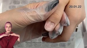 ТРЕЩИНА В НОГТЕ | ЧТО ДЕЛАТЬ ЕСЛИ ТРЕСНУЛ НОГОТЬ? ТРЕЩИНА НА НОГТЕ | КАНАЛООБРАЗНАЯ ДИСТРОФИЯ