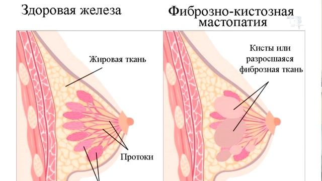 Профилактика рака молочной железы смотреть онлайн
