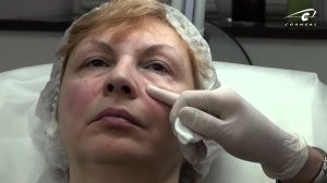 Куда и как колоть канюлей - важные нюансы