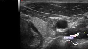 Детское УЗИ щитовидной железы - Близкие друзья