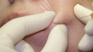 Коррекция носогубных складок канюлей. Overage Deep (Mesotech, Italy)