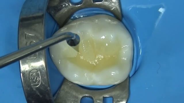 Секционная методика. Побугорковое восстановление