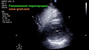 Эхокардиография - Гипокинезия перегородки левого желудочка