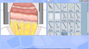 Кишечные швы - Анастомоз | Конец в конец