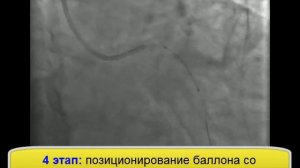 Реканализация и стентирование коронарных артерий