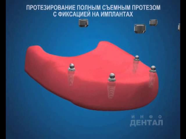 Съемные протезы на имплантах