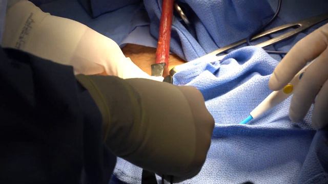 Radical Orchiectomy for Testicular Cancer смотреть онлайн