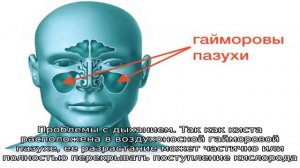 Симптоматика и особенности кисты гайморовой пазухи