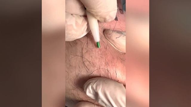 Электроэпиляция лицо результат одного сеанса