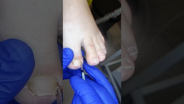 Убираю  безболезненно осколок вросшего ногтя/I clean off a piece of ingrown nail painlessly