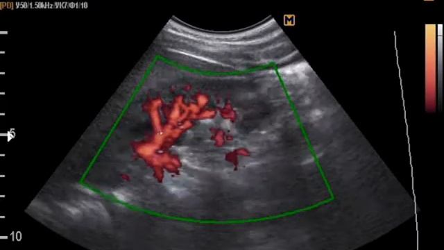 Удвоение сосудов почки смотреть онлайн