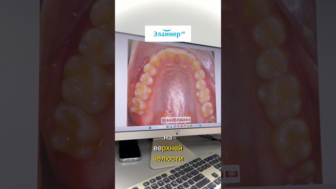 ИСПРАВЛЕНИЕ ПРИКУСА. Как это происходит #стоматологиямосква#элайнеры #брекеты #стоматолог #зубы