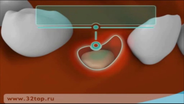 Альвеолит после удаления зуба мудрости фото Альвеолит лунки - смотреть видео онлайн от "Друг Стоматолога" в хорошем качестве