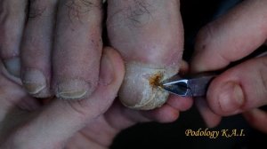 Toenail fungus cure. #Podology. #Podologia.