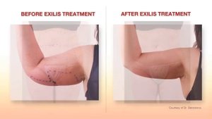 Аппарат Exilis До и После