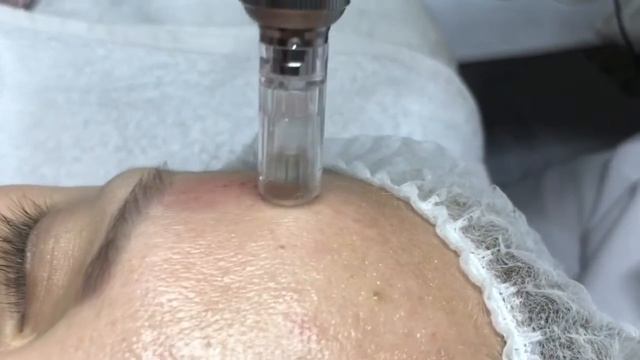 Фракционная мезотерапия смотреть онлайн