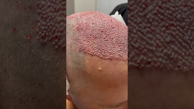 #пересадкаволос #hairlosstreatment #трансплантацияволос #hairtransplant