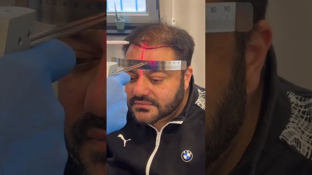 Hair transplant in Turkey | Пересадка волос в Турции #hairtransplant #пересадкаволос смотреть онлайн