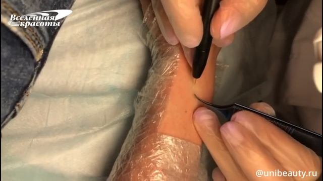 Электроэпиляция руки методом бленд смотреть онлайн