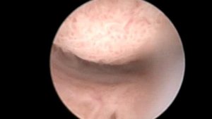 cervical endometriosis