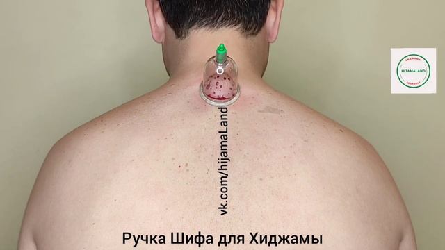 Главные точки Хиджамы, ручкой Шифа!