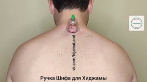 Главные точки Хиджамы, ручкой Шифа!