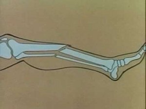 Виды переломов