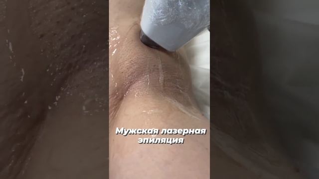 Мужская лазерная эпиляция