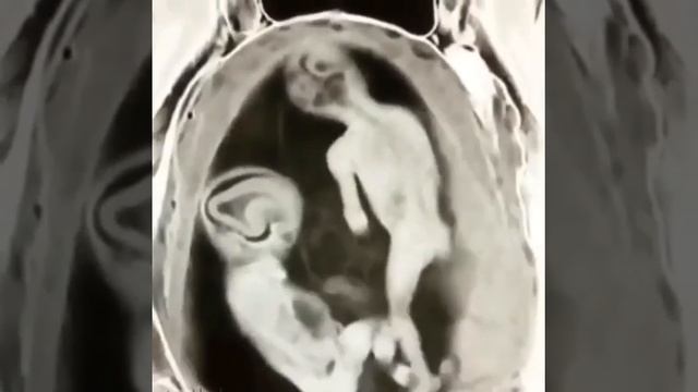 УЗИ двойняшки смотреть онлайн