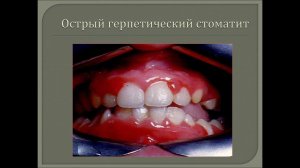 Лекция №2 ч.1 для студентов 5 курса 9 семестра "Заболевания слизистой оболочки полости рта"