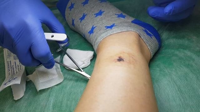 Снятие повторных швов после удаления дерматофибромы