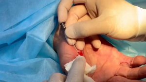 Малоинвазивное лечение контрактуры Дюпюитрена - игольная апоневротомия