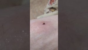 Укус клеща. Как нужно поступить в этом случае.